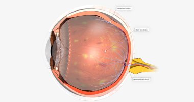 Diabetic retinopathy is a complication of diabetes that affects the eyes. 3D rendering