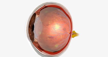 Diabetic retinopathy is a complication of diabetes that affects the eyes. 3D rendering