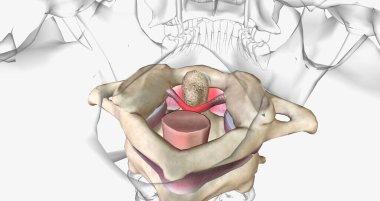 The Rheumatoid Arthritis in Cervical Spine 3D rendering