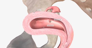 Endometrial polyps are abnormal growths of the inner lining of the uterus, known as the endometrium. 3D rendering