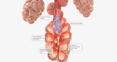 COVID-19, Acute Respiratory Distress Syndrome 3D rendering