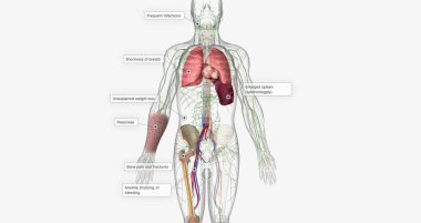 Chronic lymphoblastic leukemia develops slowly and may not immediately cause symptoms. 3D rendering
