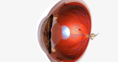 Myopia, is a common visual condition in which the eye s ability to focus on distant objects is impaired. 3D rendering