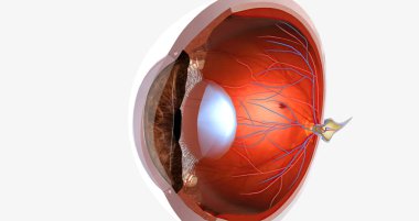 Myopia, is a common visual condition in which the eye s ability to focus on distant objects is impaired. 3D rendering
