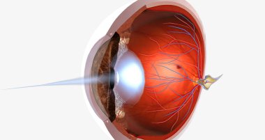 Myopia, is a common visual condition in which the eye s ability to focus on distant objects is impaired. 3D rendering