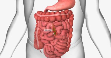 Diarrhea is the passage of loose, watery stool. 3D rendering