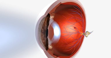 Myopia, is a common visual condition in which the eye s ability to focus on distant objects is impaired. 3D rendering