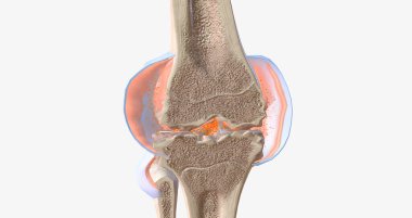 RA is caused by immune cells attacking the body's own synovial membranes, leading to joint swelling and the formation of auto-antibodies. 3D rendering