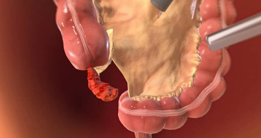 Locating and Grasping the Appendix 3D rendering