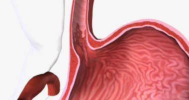 Barretts esophagus is a condition in which the tissue lining the esophagus is replaced by tissue that is similar to the intestinal lining. 3D rendering