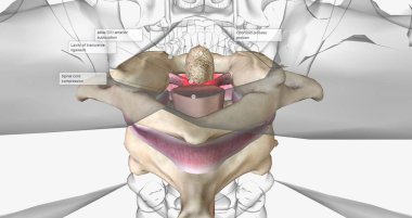 The Rheumatoid Arthritis in Cervical Spine 3D rendering