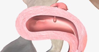 Endometrial polyps are abnormal growths of the inner lining of the uterus, known as the endometrium. 3D rendering