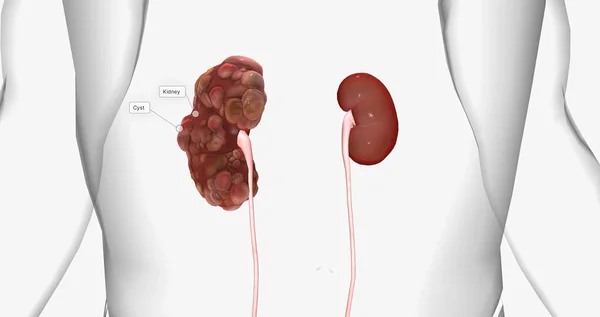 Polycystic kidney disease (PKD) is an inherited disorder of the kidneys. 3D rendering