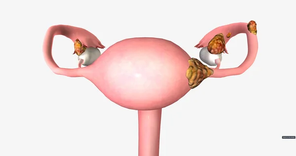 Stage Ovarian Tumor Has Spread Nearby Organs Uterus Body Fallopian — Stockfoto