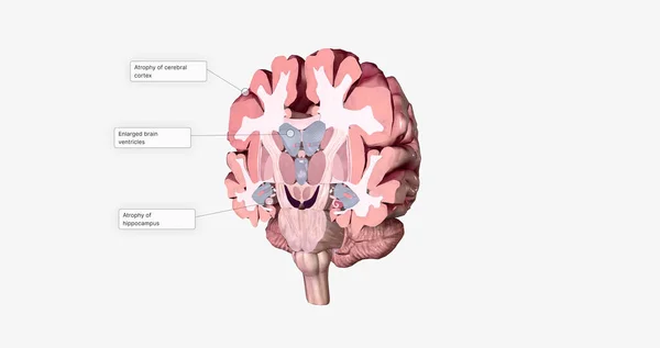 Alzheimer\'s Disease Brain Cross Section 3D rendering