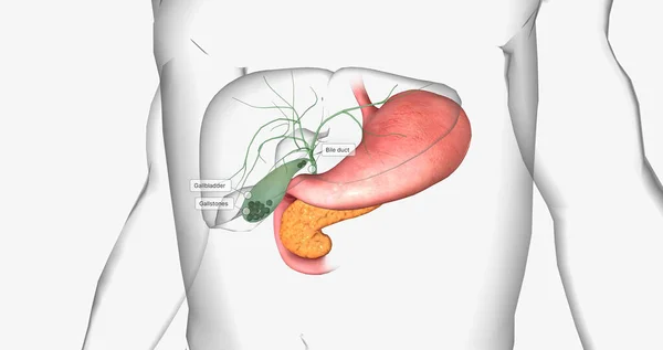 Gallstones are pieces of solid material that form in the gallbladder, a small hollow organ located beneath the liver. 3D rendering