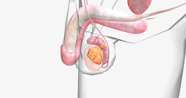 Stage Tumor Has Spread Epididymis Vessels Testicle Spermatic Cord Scrotum — стоковое фото