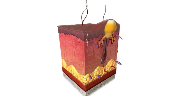 stock image Acne is caused by a combination of factors acting on sebaceous glands and hair follicles in the skin. 3D rendering