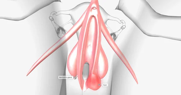 Bartholins Cyst Occurs Woman Bartholin Glands Glands Responsible Lubricating Vagina — Foto de Stock