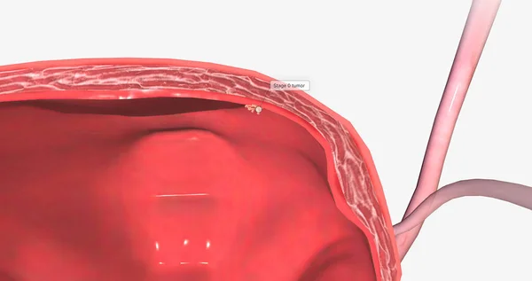 Bladder cancer is a type of cancer that originates in the urothelial cells of the bladder. 3D rendering