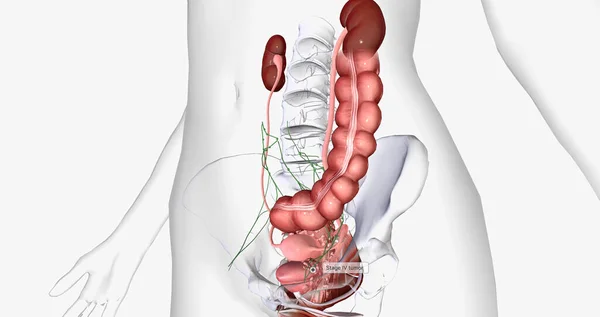 Stage Cancer Spreads Invade Nearby Organs Bladder Rectum Kidneys Rendering — стоковое фото