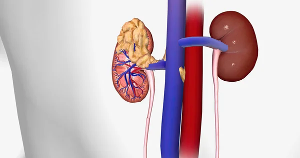 Kidney Cancer Stage Rendering — стоковое фото