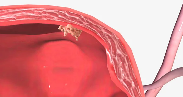 In stage I bladder cancer 3D rendering