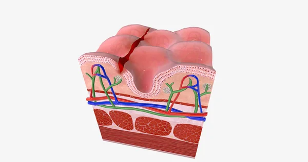 Anal Fissure Small Tear Lining Anal Mucosa Rendering — Foto de Stock