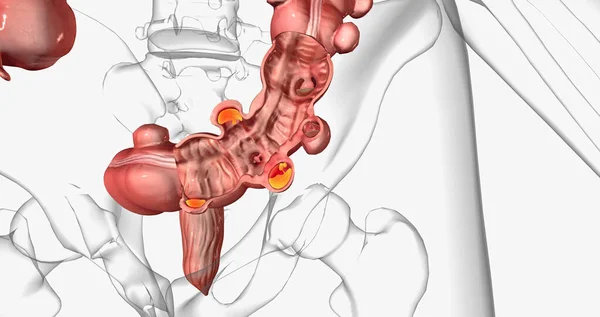 Diverticulosis occurs when small, bulging pouches develop in your digestive tract. 3D rendering