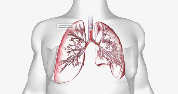 Cystic fibrosis is a genetically inherited disease that affects secretory cells throughout the body. 3D rendering