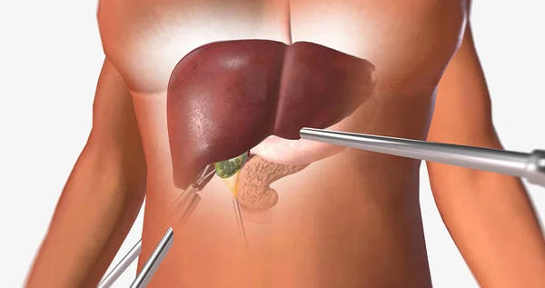 Locating and Retracting the Gallbladder 3D rendering