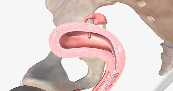 Endometrial polyps are abnormal growths of the inner lining of the uterus, known as the endometrium. 3D rendering