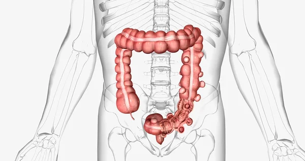 Diverticulosis Condition Characterized Formation Diverticula Walls Intestines Rendering — Zdjęcie stockowe