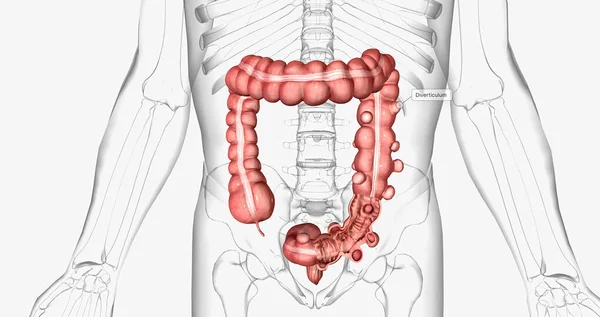 Diverticulosis Condition Characterized Formation Diverticula Walls Intestines Rendering — Foto Stock