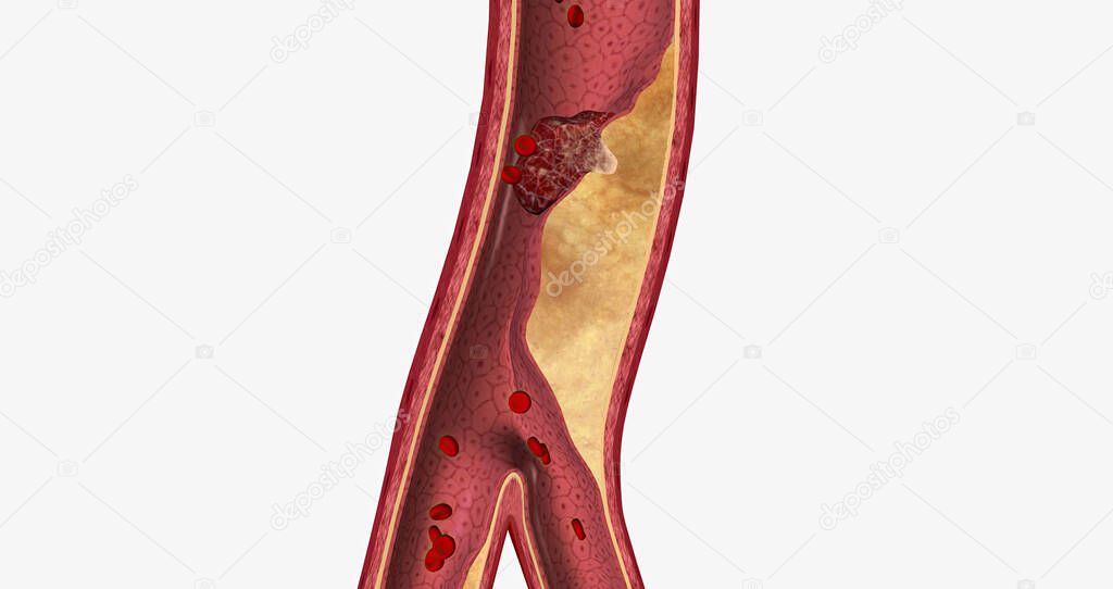Atherosclerosis is a cardiovascular disease characterized by the