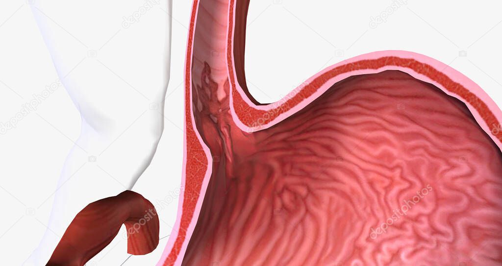 Barretts esophagus is a condition in which the tissue lining the