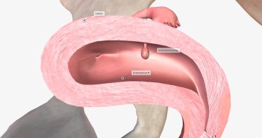 Endometrial polyps are abnormal growths of the inner lining of the uterus, known as the endometrium. 3D rendering