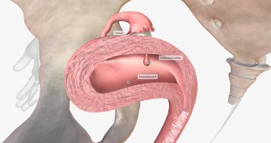 Endometrial polyps are abnormal growths of the inner lining of the uterus, known as the endometrium. 3D rendering clipart
