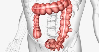 Diverticulosis is a condition characterized by the formation of diverticula in the walls of the intestines. 3D rendering