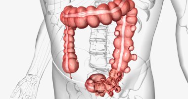 Diverticulosis is a condition characterized by the formation of diverticula in the walls of the intestines. 3D rendering clipart