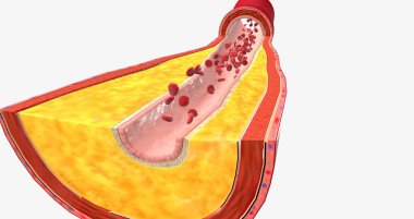 Atherothrombosis is a cardiovascular disease characterized by ruptured atherosclerotic plaque and clot formation. 3D rendering