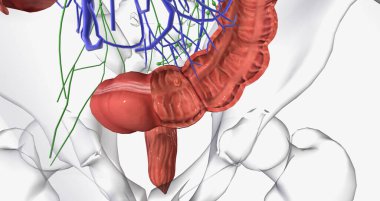 Colorectal cancer (CRC) is a common colon or rectal cancer that affects many patients over middle age. 3D rendering