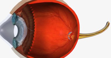 Keratoconus is an eye disease that affects the structure of the cornea. 3D rendering
