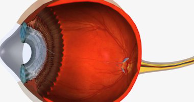 Keratoconus is an eye disease that affects the structure of the cornea. 3D rendering
