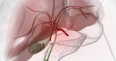 Gallstones are pieces of solid material that form in the gallbladder, a small hollow organ located beneath the liver. 3D rendering