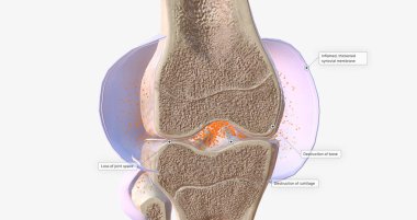 RA is caused by immune cells attacking the body's own synovial membranes, leading to joint swelling and the formation of auto-antibodies. 3D rendering