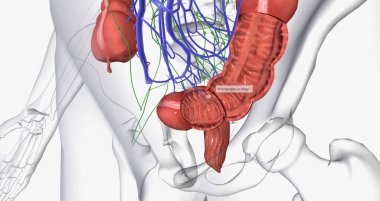 Colorectal cancer (CRC) is a common colon or rectal cancer that affects many patients over middle age. 3D rendering