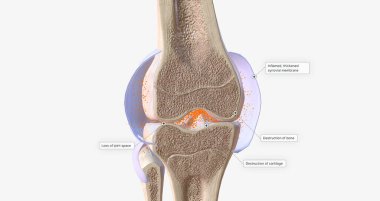 RA is caused by immune cells attacking the body's own synovial membranes, leading to joint swelling and the formation of auto-antibodies. 3D rendering