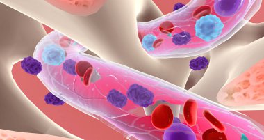 Lymphoblasts invaded and eventually replace healthy bone marrow, preventing the production of blood cells. 3D rendering
