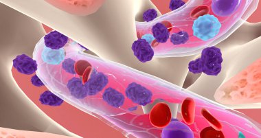 Lymphoblasts invaded and eventually replace healthy bone marrow, preventing the production of blood cells. 3D rendering